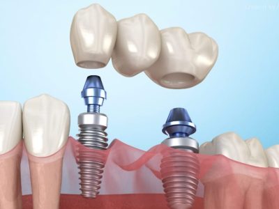 FOTO IMPLANTES (1) FOTO IMPLANTES (1)